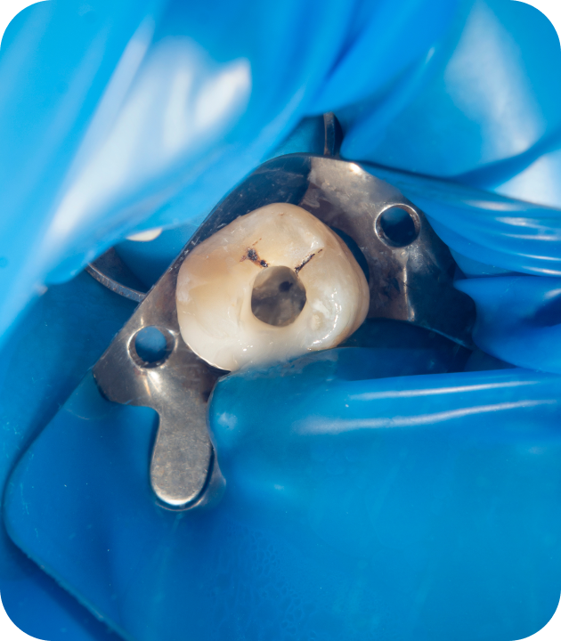 Perforation endodontique endodontie Villeneuve-d-Ascq