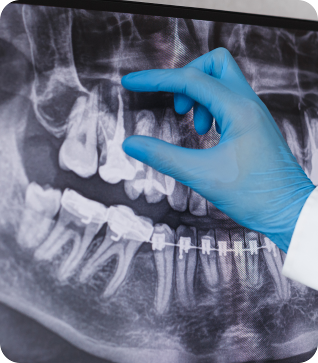 Retraitement endodontique Villeneuve-d-Ascq