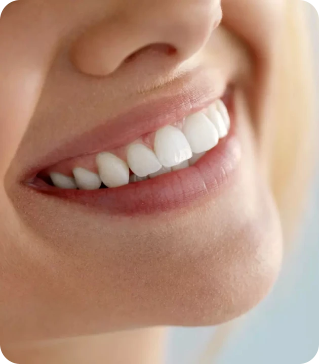 sourire eclaircissement interne