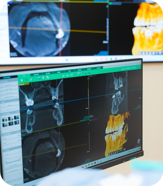 traitement endodontique anatomie complexe Villeneuve-d-Ascq